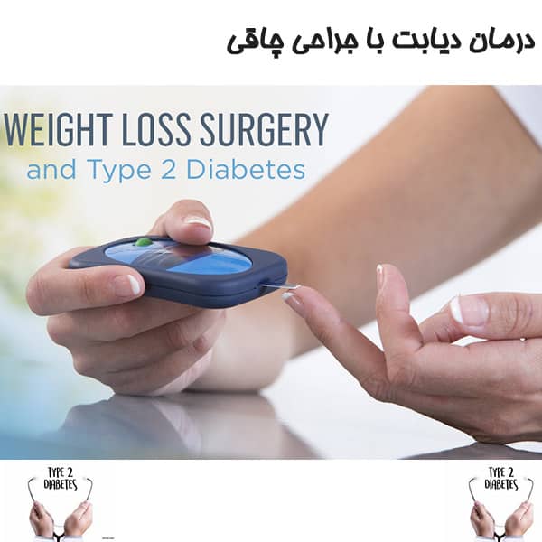 درمان دیابت با جراحی چاقی