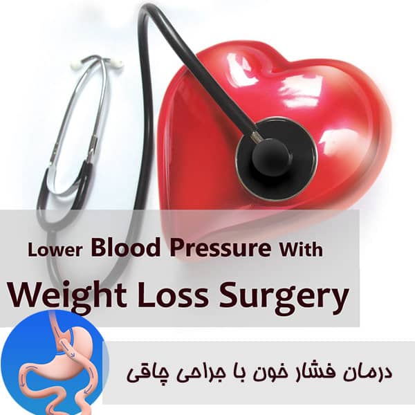 درمان فشار خون با جراحی چاقی