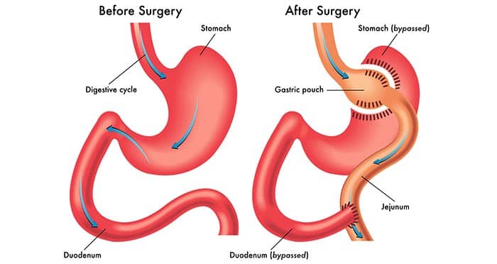 انواع جراحی چاقی 2