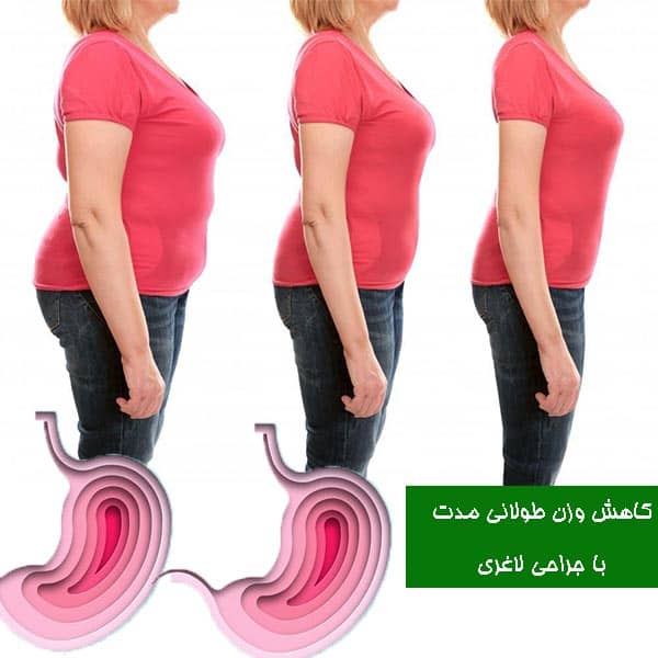 کاهش وزن طولانی مدت با جراحی لاغری