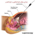 جراحی چاقی لاپاراسکوپی و لاپاراتومی