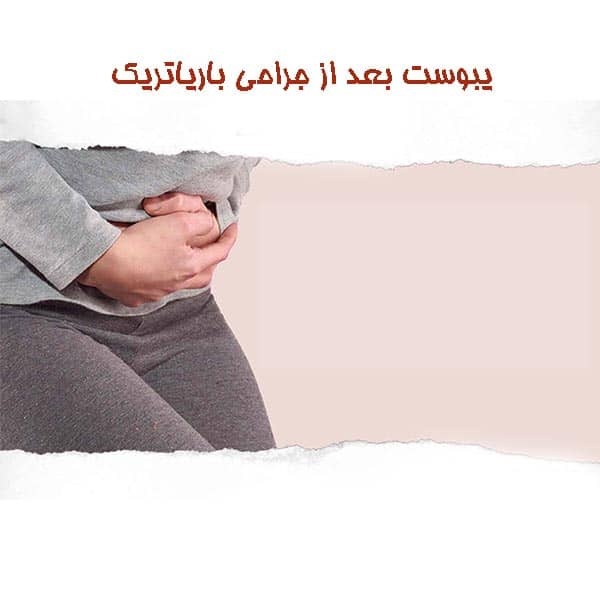 یبوست بعد از جراحی باریاتریک