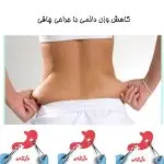 کاهش وزن دائمی با جراحی چاقی